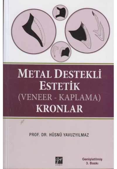 Metal Destekli Estetik (Veneer-Kaplama) Kronlar